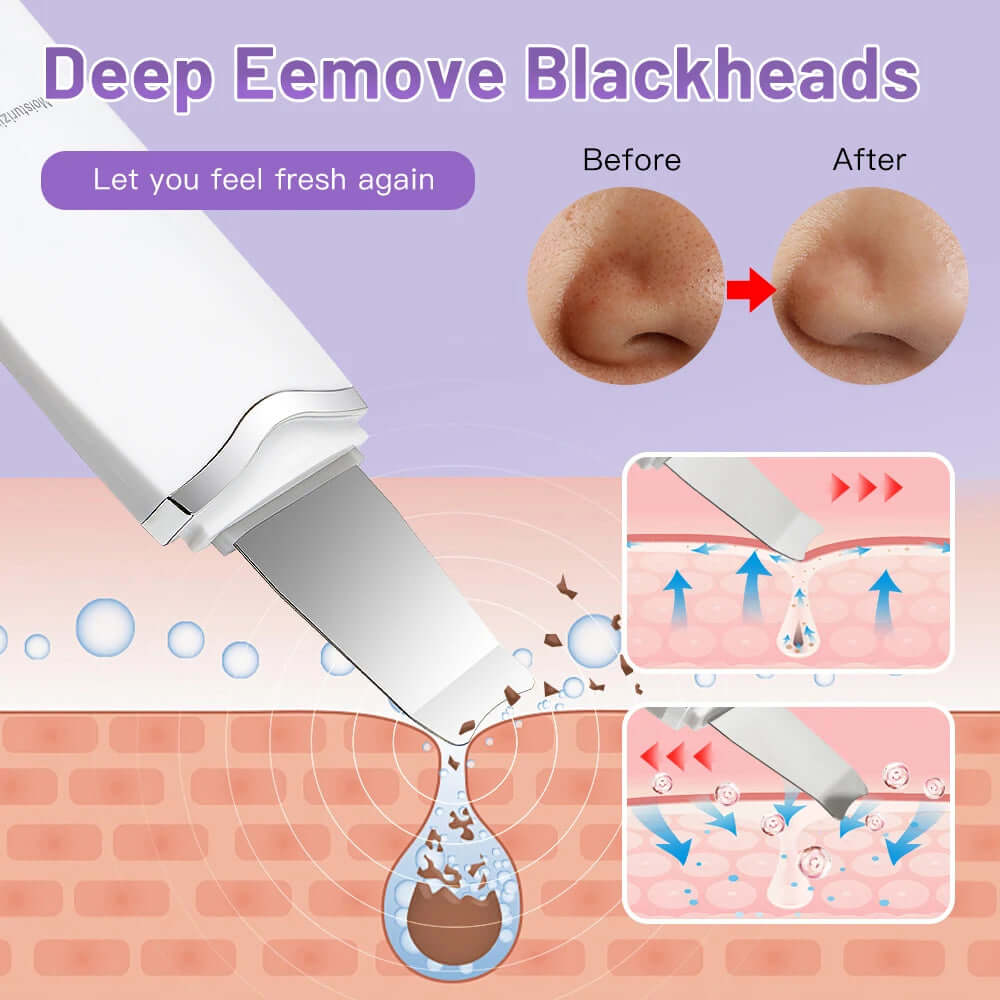 Facial Ultrasonic Skin Scrubber - Viva Bella