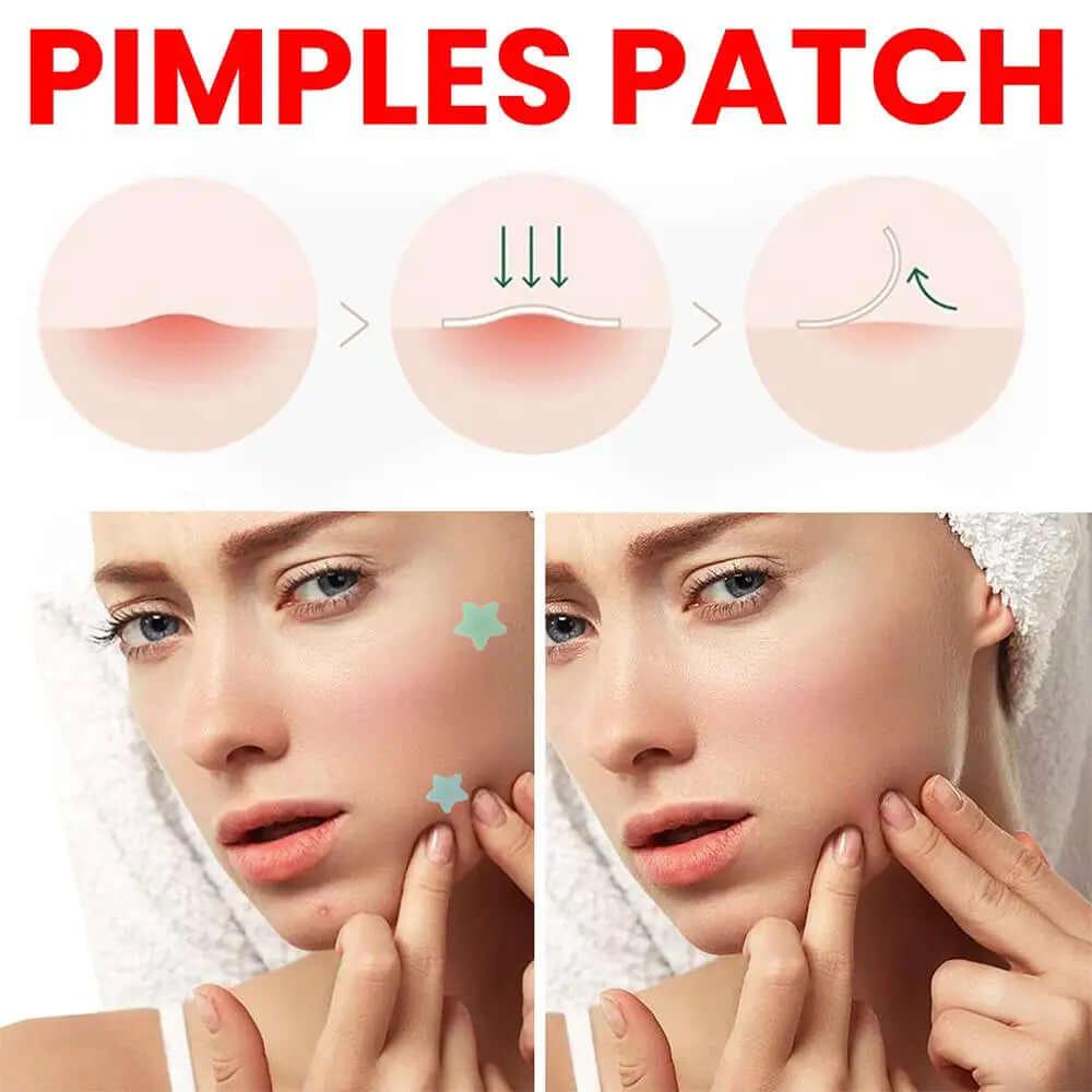 200pcs Star Acne Pimple Patches Colorful Breathable Removal Pimple Absorb Secretions Anti Infection Concealer Makeup Skin Care - Viva Bella