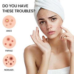 200pcs Star Acne Pimple Patches Colorful Breathable Removal Pimple Absorb Secretions Anti Infection Concealer Makeup Skin Care - Viva Bella